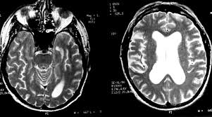 The differential diagnoses include limbic encephalitis (paraneoplastic), gliomatosis cerebri, and status epilepticus. Atypical Herpes Type 2 Encephalitis Associated With Normal Mri Imaging Journal Of Neurology Neurosurgery Psychiatry
