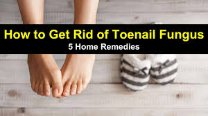 Toenail fungus also known as onychomycosis is caused by a group of fungus called dermatophytes. How To Get Rid Of Toenail Fungus 5 Home Remedies