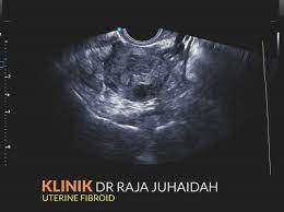 Tempoh pemulihan selepas pembedahan buang rahim. Pembedahan Pembuangan Fibroid Atau Myomectomy Dr R Juhaidah Blog