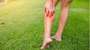 Blood poisoning happens as bacteria that trigger infection inside several parts of the body enter the bloodstream. 2021 News Video Black Mosquito Bites Cause Dangerous Blood Poisoning