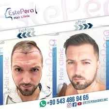 Fut the recommended procedures are follicular unit transplantation (fut) and fue. African American Hair Transplant Estepera