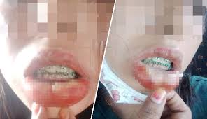 Pendakap gigi (braces) palsu beri kesan buruk. Belanja Rm190 Untuk Fake Braces Akibatnya 3 Minggu Tanggung Sakit Bibir Bengkak Teruk The Reporter
