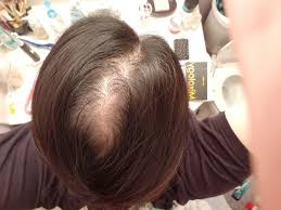 Have you been experiencing excessive hair loss lately? Pcos Related Hair Loss I M On Spiro Rogaine And I Dermaroll Not Sure Whats Left For Me Femalehairloss