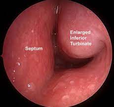 When a deviated septum is severe, it can block one side of your nose and reduce airflow, causing difficulty breathing. Enlarged Turbinates Henry Ford Health System Henry Ford Health System Detroit Mi