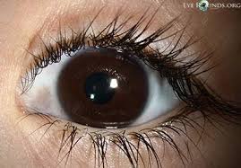 Image result for nevus sclerae