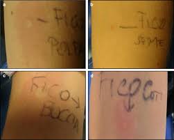 Check spelling or type a new query. Adverse Reaction To Ficus Carica Reported Case Of A Possible Cross Reactivity With Der P1 Clinical And Molecular Allergy Full Text