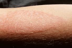 Resultado de imagen para Dermatitis atÃ³pica