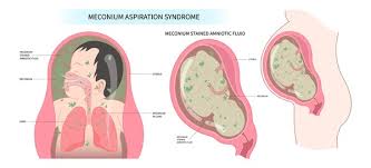 Image result for Chorioamnionitis