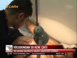 Vucudundan 50 Kene Cikti Youtube
