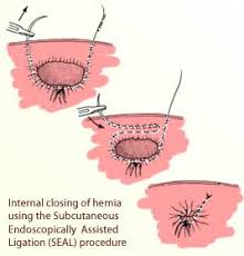 Image result for Inguinal hernia child