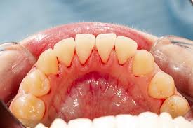 Image result for gums cancer symptoms