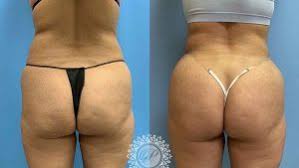 Maybe you would like to learn more about one of these? Brazilian Butt Lift Chicago Nw In Petrungaro Plastic Surgery
