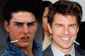 We talk to a woman who had a nose job to find out what it's really like to get plastic surgery. Did Tom Cruise Have Plastic Surgery Before After Photos
