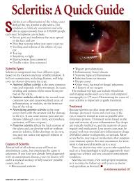 Image result for Scleritis