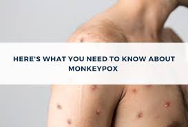 Image result for Monkeypox