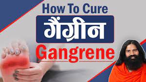 On april 12, 1961, soviet cosmonaut gagarin blasted off in a vostok rocket and he orbited earth for 108 minutes. How To Cure Gangrene à¤— à¤— à¤° à¤¨ Swami Ramdev Youtube