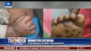 Monkeypox is a rare disease that is caused by infection with monkeypox virus. 2 Patients Diagnosed With Monkey Pox Get Clean Bill Of Health Youtube