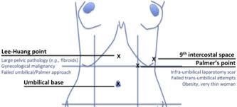 In the latif's point group, the mean pneumoperitoneum time was 0.8 0.002 min, and it was 1.08 0.007 min in the palmer's point group (p ≤ 0.5). Abdominal Wall Flashcards Quizlet