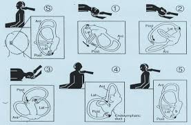 Image result for Canalith Repositioning Procedure