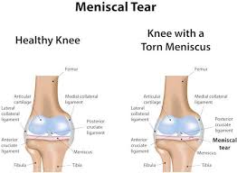 Beneficial And Repairing Knee Strengthening Exercises For A Meniscus Tear Gymguider Com In 2020 Meniscus Tear Knee Strengthening Exercises Meniscus Tear Treatment