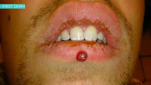 Image result for Pyogenic Granuloma