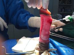 درمان انحناء آلت تناسلی | وب سایت دکتر حسین کرمی