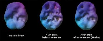 The adhd brain does not seem to be properly controlled by the limbic system, and so individuals with adhd may have wild mood swings or are unable to control emotional outbursts. Adhd Add Counseling Successful Tools And Strategies Sheri Bland Solutions Ltd