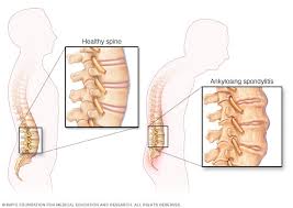 A backbone can tie together diverse networks in the same building, in different buildings in a campus environment. Ankylosing Spondylitis Symptoms And Causes Mayo Clinic
