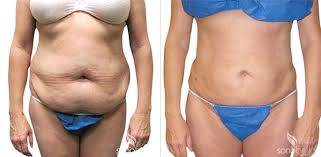 Before And After Gallery Sono Bello Total Body Transformation Centers Image Source Sono Bello Website Transformation Body Liposuction Increase Bust Size