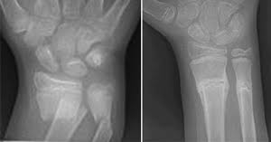 What signs should parents be looking for? Broken Arm Causes Signs And Treatment The Hand Society
