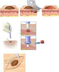 The type of cancer depends on the layer in which it starts. Skin Biopsy Is The Current Standard For Skin Conditions Diagnosis The Download Scientific Diagram
