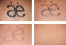 Many factors will determine how long it will take to remove a tattoo. Lemon Juice Remove Tattoo Home Done Tattoo Removal