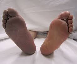Aunque las varices en las piernas pueden ser una de las causas de la enfermedad de trombosis, estas son unas dilataciones venosas en las que no siempre existe un trombo, tal y como indican desde. Trombosis Wikipedia La Enciclopedia Libre