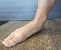 Posterior Tibial Tendon Dysfunction Pttd On The Ball Orthotics Barrie