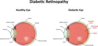 Check spelling or type a new query. Diabetic Diseases Of The Eye Vision Center