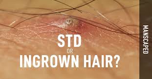 The common symptoms associated with ingrown hair are discussed here.as the infections kick the ingrown hair on the vagina takes a form of vaginal boil or cyst or sore. Kumpulan Soal Pelajaran 9 Hair Bumps In Pubic Area