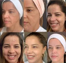 Peeling Quimico Cochabamba