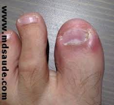 Image result for Paronychia feet