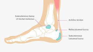 Lateral malleolus fractures cause pain, swelling, and bruising around the ankle. Bursitis Ankle Bursa Care And Prevention