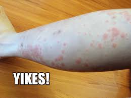 Image result for pruritic urticarial papules and plaques of pregnancy