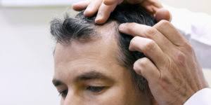 Hair cells are one of the fastest growing cells in our body. List Of Medications Or Drugs That Can Cause Hair Loss