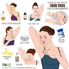 9 Remedies To Remove Skin Tags Naturally Top 10 Home Remedies Remove Skin Tags Naturally Skin Tags Home Remedies Skin Tag Removal