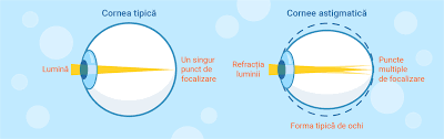 Acest tip de cristalin este produs pe comanda, iar perioada de asteptare este de maxim 2 luni. Acomodarea Vizuala Opticas Tratament Acomodarea Vederii