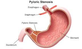 Pyloric Stenosis Causes Signs And Symptoms Diagnosis And