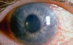 الجلوكوما المياه الزرقاء Glaucoma Blue Water الطبي دليل الدواء وعلاج المرض