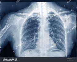 New updated version 21 out now. X Ray Image Of Human Chest For A Medical Diagnosis Ad Affiliate Human Image Ray Diagnosis Photo Editing X Ray X Ray Images