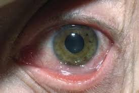 As you see in the diagram above, the virus will collect, then begin irritating the skin. Herpes Simplex Eye Infections Nhs