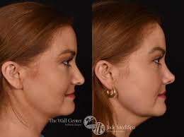 Rhinoplasty Before and After Pictures Case 995