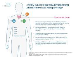 Some causes of hypotension include blood loss. Lithium Induced Hyperparathyroidism Clinical Features And Management