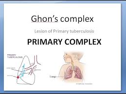 You must finish your medicine and take the drugs exactly as prescribed. Pathology 158 A Ghon Complex Primary Tuberculosis Secondary Lung Focus Children Child Miliary Lesion Youtube